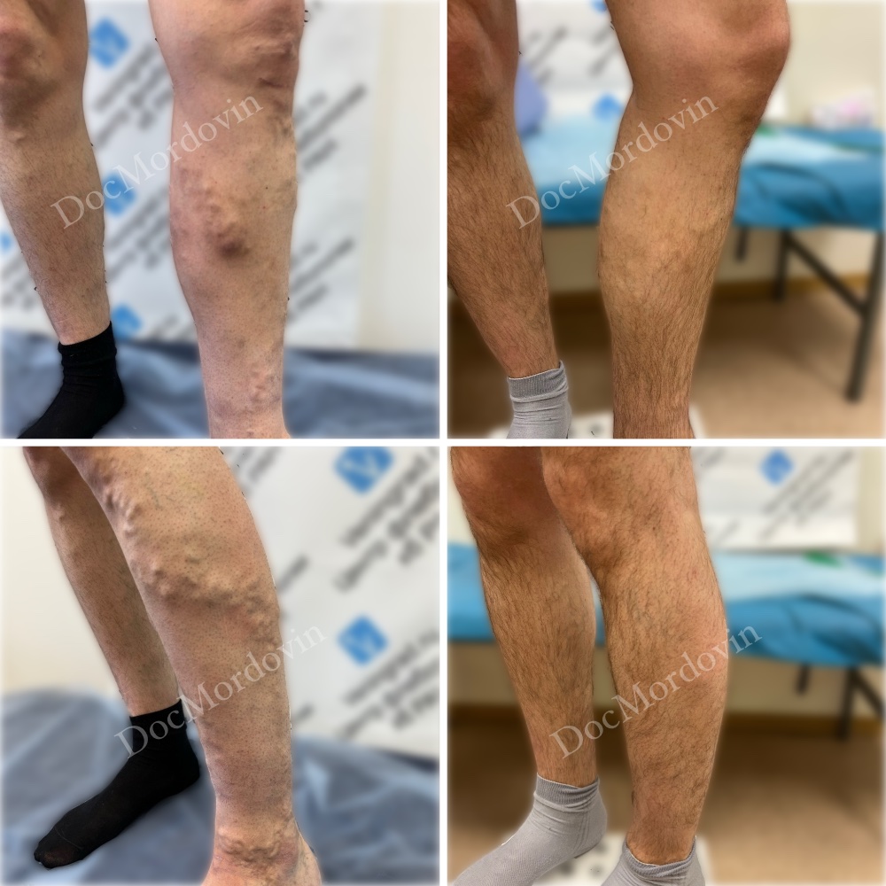 Результат ЭВЛК через 6 месяцев