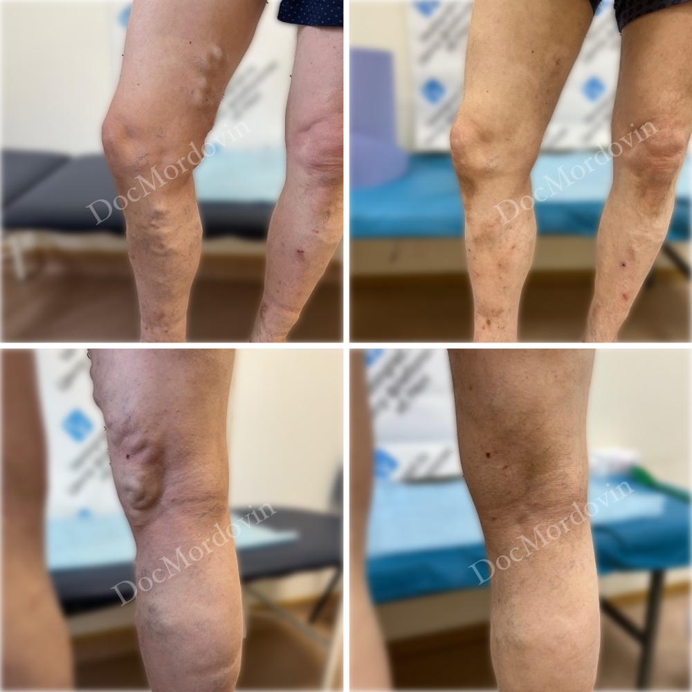 Результат ЭВЛК через 1 год