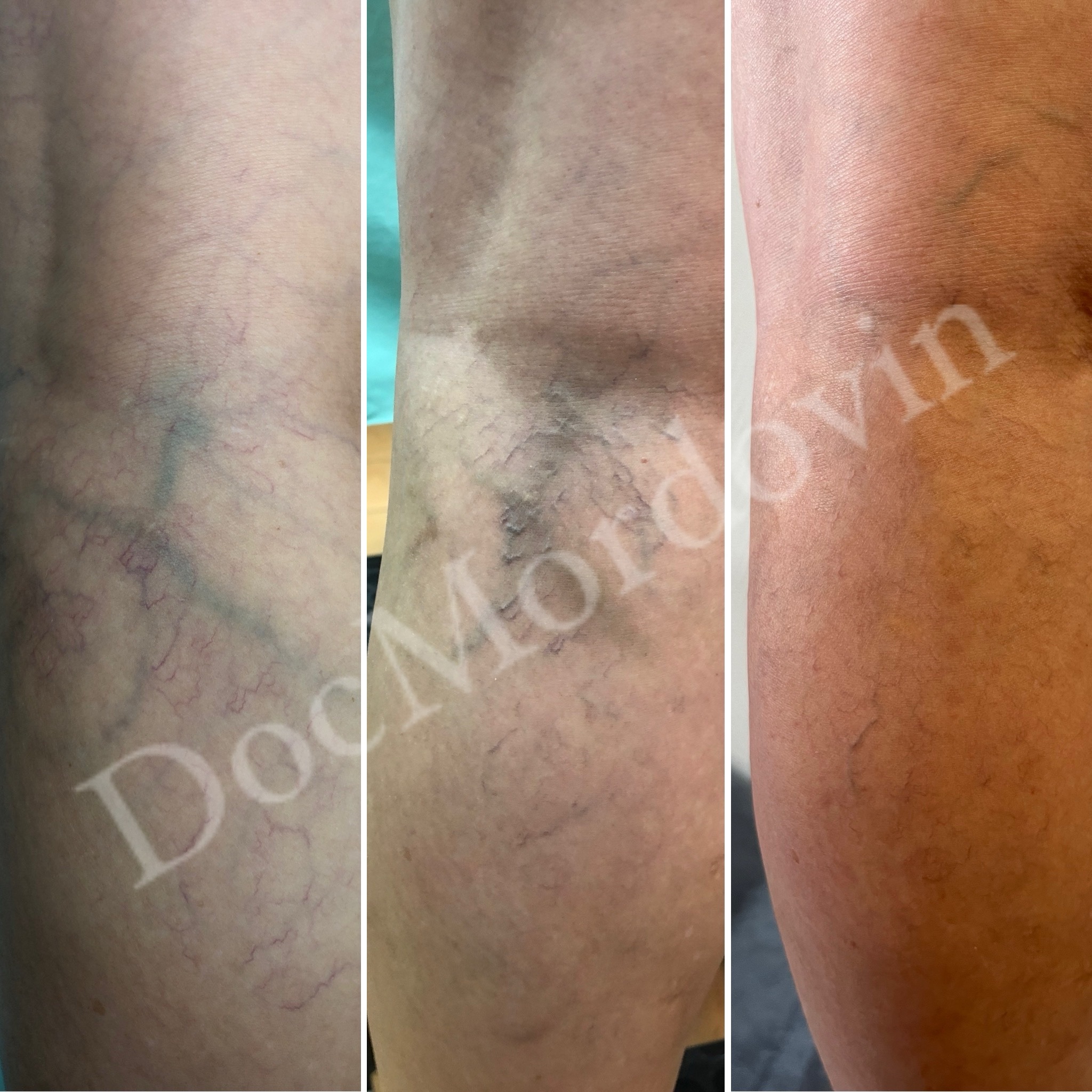 Результат склеротерапии